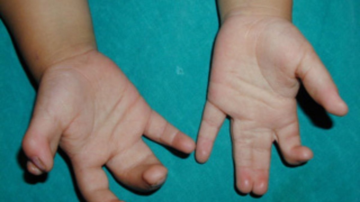 Sindaktili (Yapışık Parmak) Nedir? Neden Olur ve Nasıl Tedavi Edilir?