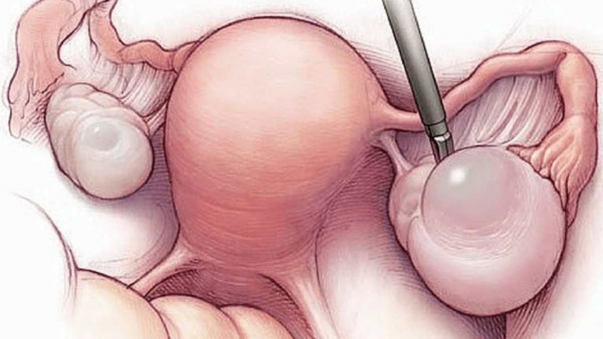Endometriozis (Çikolata Kisti) Nedir, Nasıl Anlaşılır?