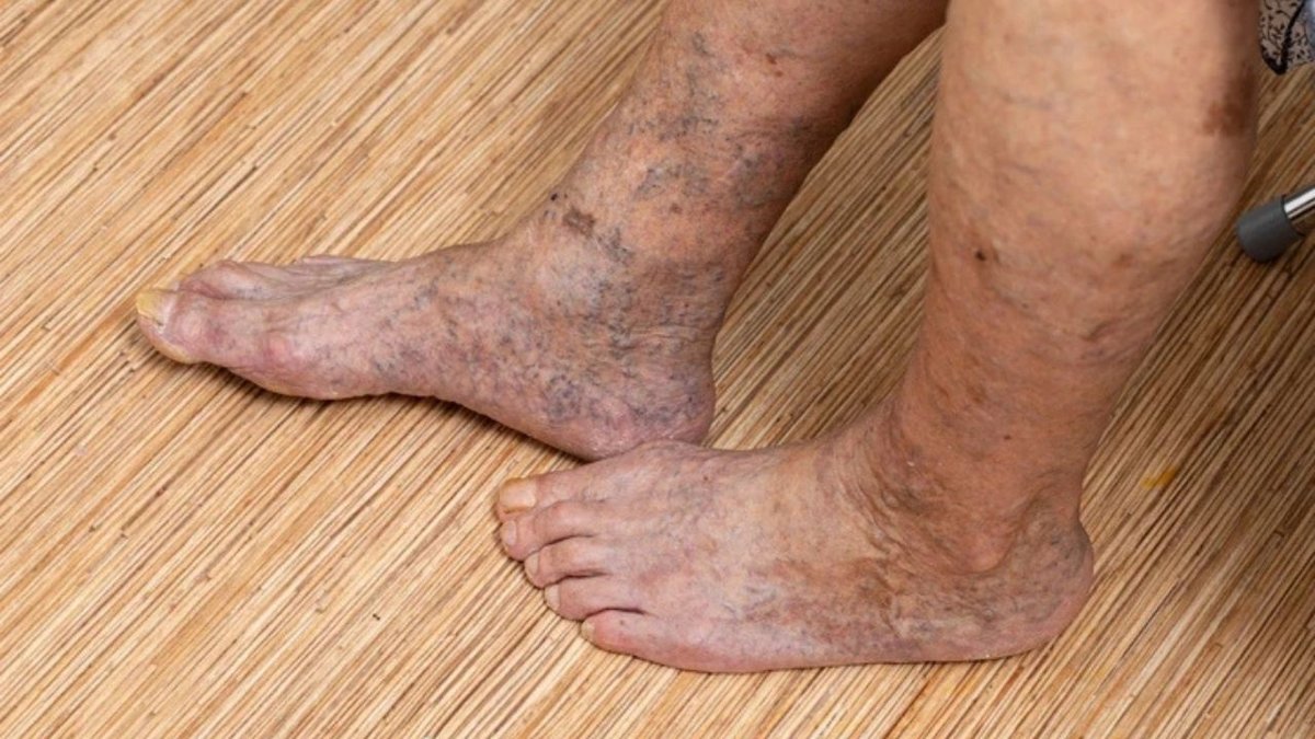 Vitrin Hastalığı Olarak Bilinen Rahatsızlık Yürüyüş Sırasında Kendini Belli Ediyor