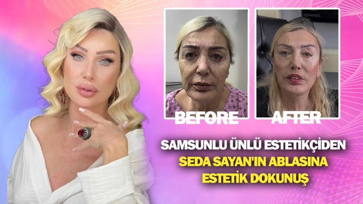 Seda Sayan’ın Ablası Nursel Sayan’ın Estetik Sonrası Değişimi Gündem Oldu